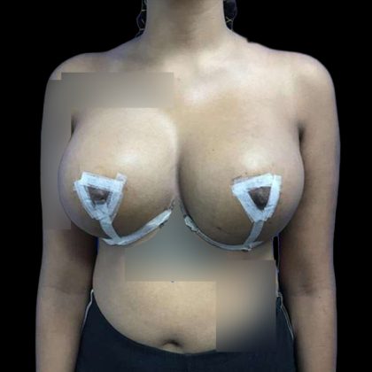 Breast Lift Before & After Patient #147
