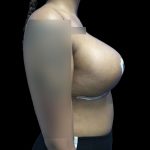 Breast Lift Before & After Patient #147