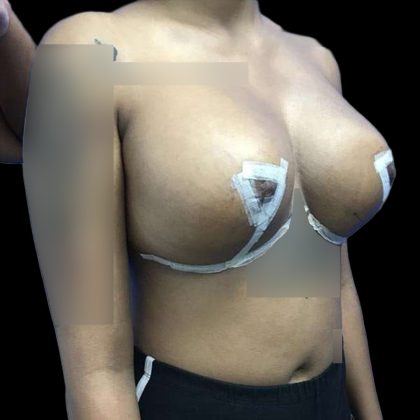 Breast Lift Before & After Patient #147