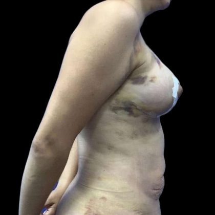 Breast Lift Before & After Patient #112
