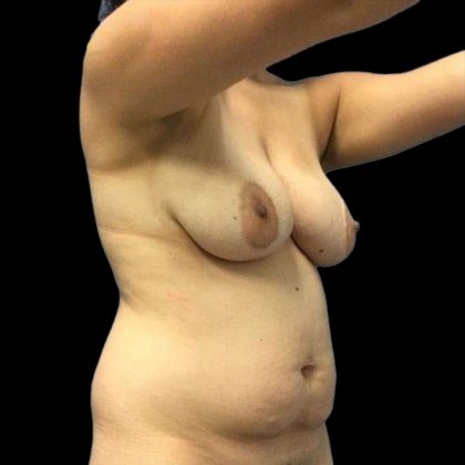 Breast Lift Before & After Patient #112
