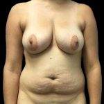 Breast Lift Before & After Patient #112