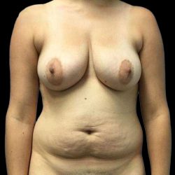 Breast Lift Before & After Patient #112