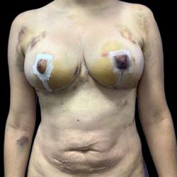 Breast Lift Before & After Patient #112