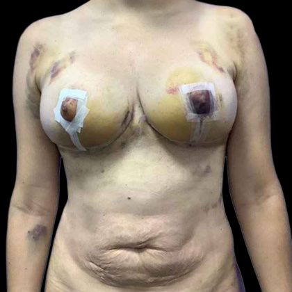 Breast Lift Before & After Patient #112