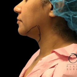Chin Lipo Before & After Patient #74