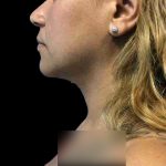 Chin Lipo Before & After Patient #74