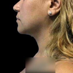 Chin Lipo Before & After Patient #74