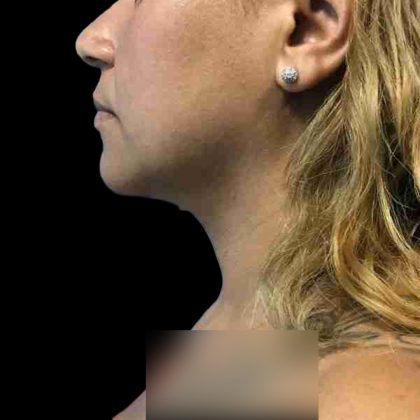 Chin Lipo Before & After Patient #74