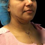 Chin Lipo Before & After Patient #74