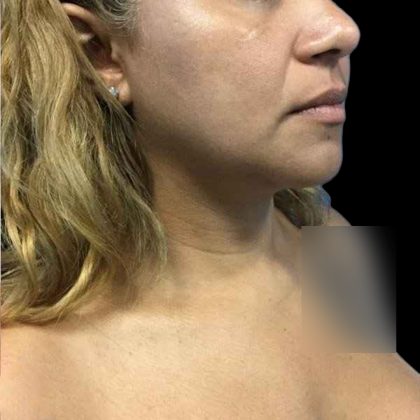 Chin Lipo Before & After Patient #74