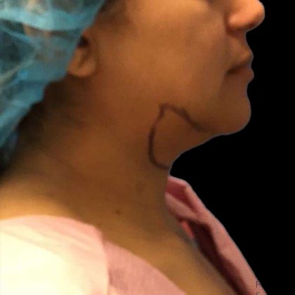 Chin Lipo Before & After Patient #74