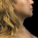 Chin Lipo Before & After Patient #74