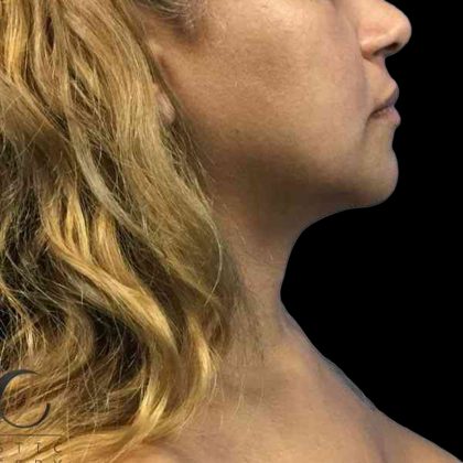 Chin Lipo Before & After Patient #74