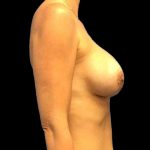 Explant Capsulectomy Before & After Patient #82
