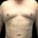 Gynecomastia Before & After Patient #161
