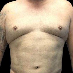 Gynecomastia Before & After Patient #161