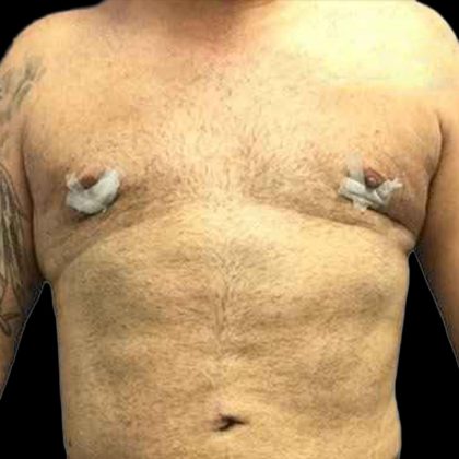 Gynecomastia Before & After Patient #161