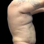 Gynecomastia Before & After Patient #161