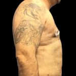 Gynecomastia Before & After Patient #161