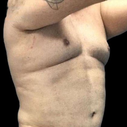Gynecomastia Before & After Patient #161