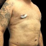 Gynecomastia Before & After Patient #161