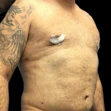 Gynecomastia Before & After Patient #161