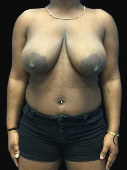 Breast Lift Before & After Patient #126