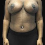 Breast Lift Before & After Patient #126