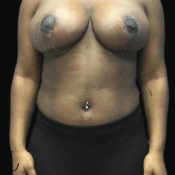 Breast Lift Before & After Patient #126