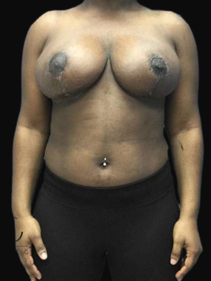 Breast Lift Before & After Patient #126