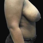 Breast Lift Before & After Patient #126