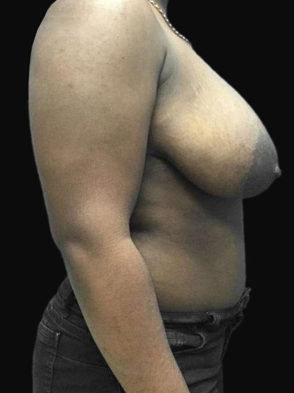 Breast Lift Before & After Patient #126