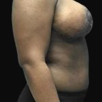 Breast Lift Before & After Patient #126