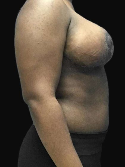 Breast Lift Before & After Patient #126