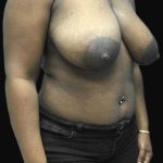 Breast Lift Before & After Patient #126
