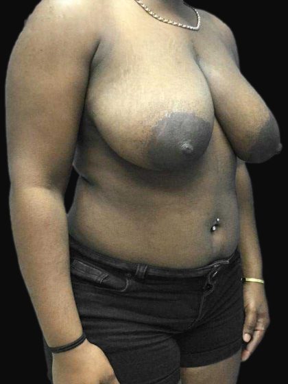 Breast Lift Before & After Patient #126