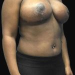 Breast Lift Before & After Patient #126