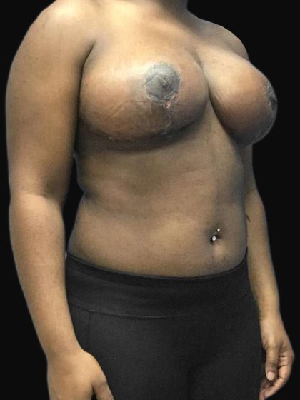 Breast Lift Before & After Patient #126