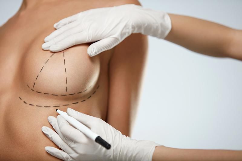 Revision Breast Surgery, Miami FL, Dr. Oliver Chang