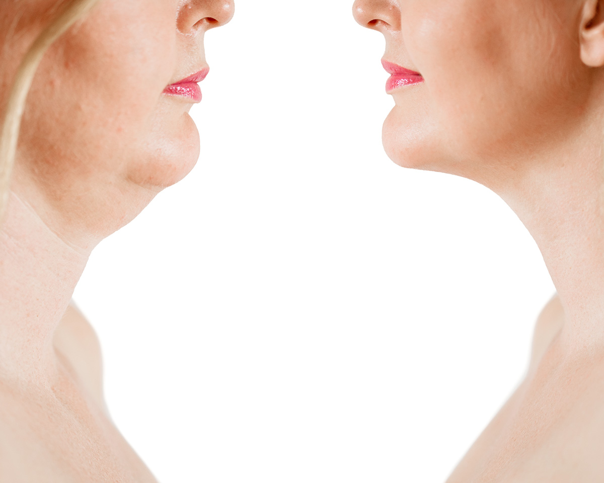 Neck Lift