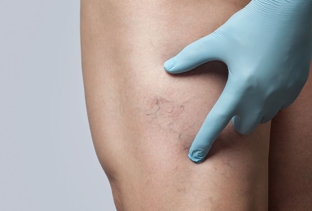 Spider Vein Treatment, Miami FL, Dr. Oliver Chang