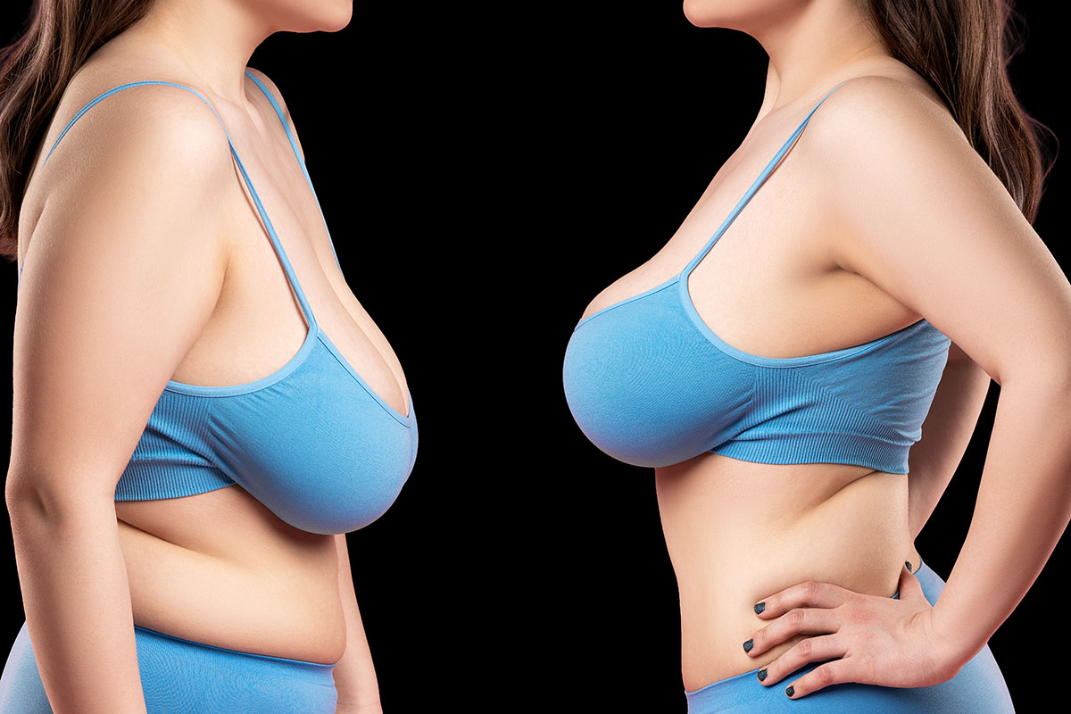 Breast Lift, Miami FL, Dr. Oliver Chang