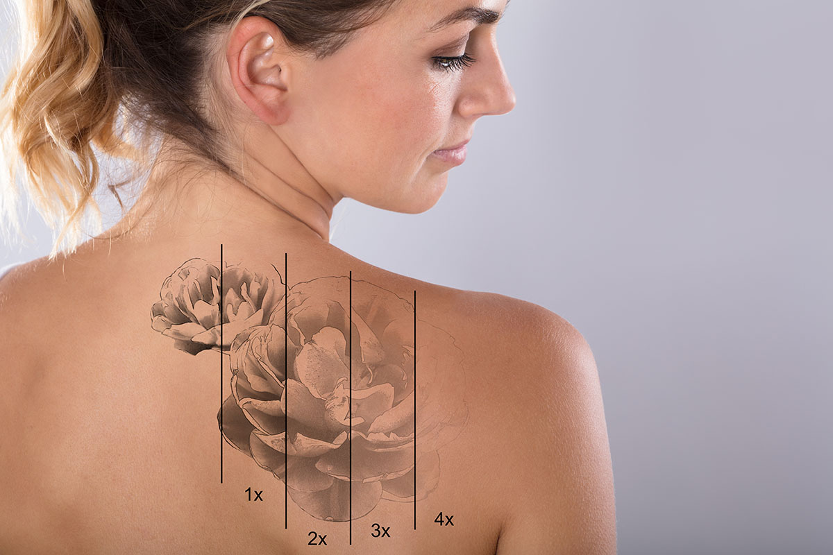 Laser Tattoo Removal